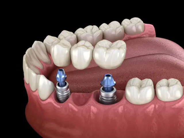 Implant-Supported Dental Bridges